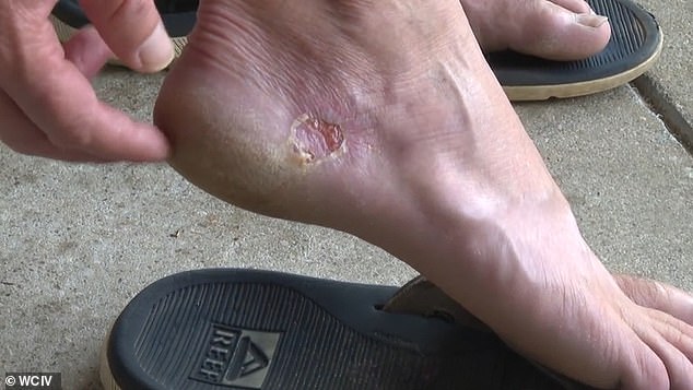 The flesh around his heel appeared blistered, red and swollen, prompting him to go to the doctor, who informed him that he had contracted Vibrio, a deadly flesh-eating bacteria.