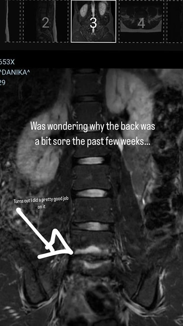 Mason, 33, shared an image of a scan on his back that appears to show painful damage to one of the discs in his spine (pictured).