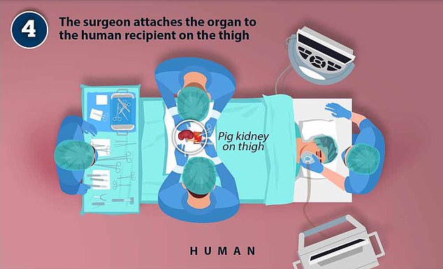 Doctors make an incision in the thigh and, using instruments, can make a tunnel to the area where the kidney is located.