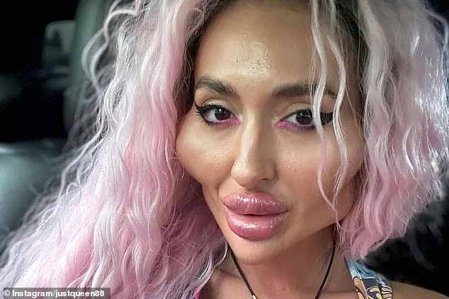 The 36-year-old Ukrainian has spent more than £1,600 giving herself injections to her face to achieve her extreme look.