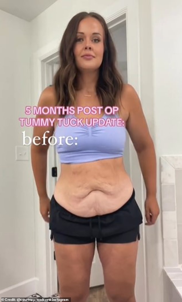 In June 2023, when she stopped the injections, she was left with almost 6 pounds (2.7 kg) of excess skin on her stomach, which she described as a 