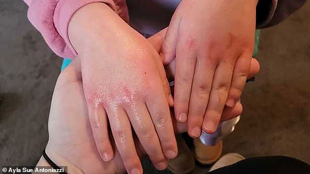 A girl shows a rash she developed shortly after returning to East Palestine in February 2023.