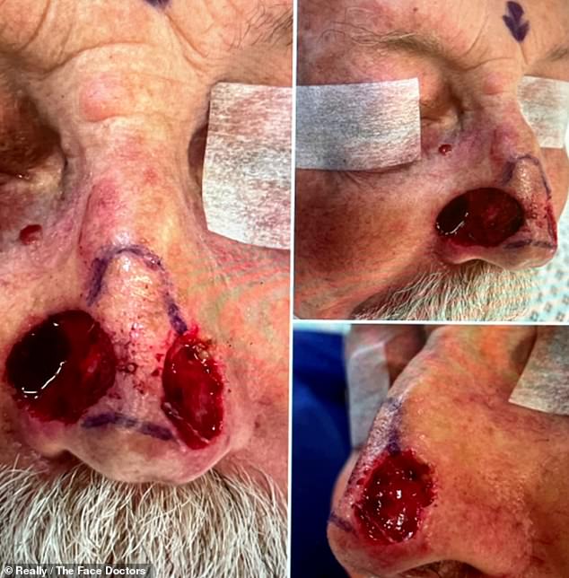 Peter had been left with two gaping holes in his nose after damage caused by skin cancer.