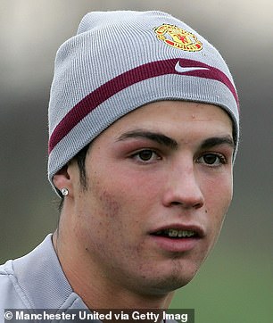 Cristiano Ronaldo has scars on his cheeks due to acne, Dr. Chu said. He appears in the photo above in 2005.