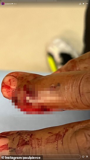 Pierce posted two photos of his finger injury.