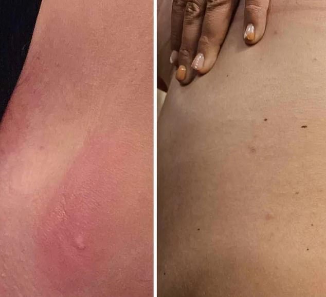 Ms McIvor said the doctor told her her lumps were bedbug bites 