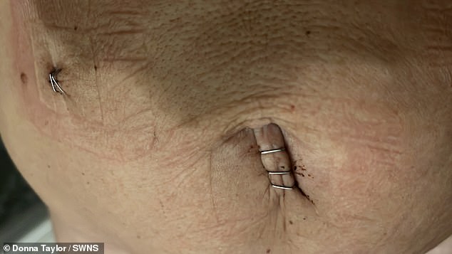 The 45-year-old woman then underwent laparoscopy and several biopsies and was diagnosed with stomach cancer in December 2023. Pictured: Donna's stomach after surgery.