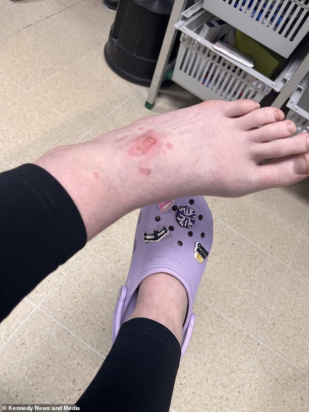 Insurance officer Mrs Owen is grateful her daughter has not been blinded by the scorching liquid and is warning other parents about the viral madness (pictured: some of the blisters on Sophie-Rose's foot).