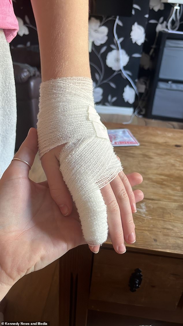 The mother of two immersed Sophie-Rose's foot and hand in cold water and noticed huge blisters appearing on the young woman's skin (pictured: the bandaged 12-year-old girl)