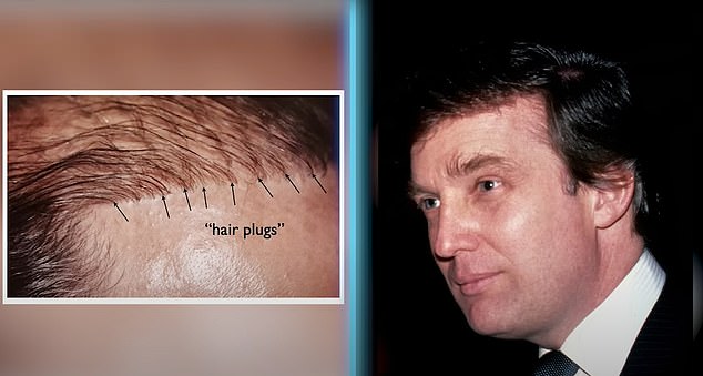 Dr. Linkov also believes that Trump had plug grafts, a type of hair transplant surgery in which surgeons take hair from the back of the head and transplant it to bald spots.