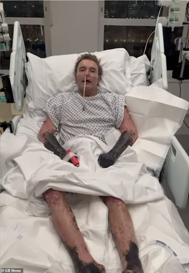 Craig Mackinlay pictured at St Thomas' hospital on November 30 with blackened limbs after suffering sepsis.