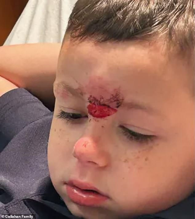 Grayson was taken to the hospital with a deep cut on his forehead and missing teeth and is now 