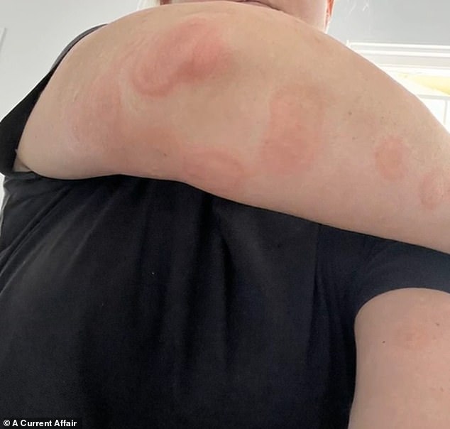 The family's holiday quickly turned sour when they discovered their beds were infested with bed bugs, leaving them with red, blistered bites.