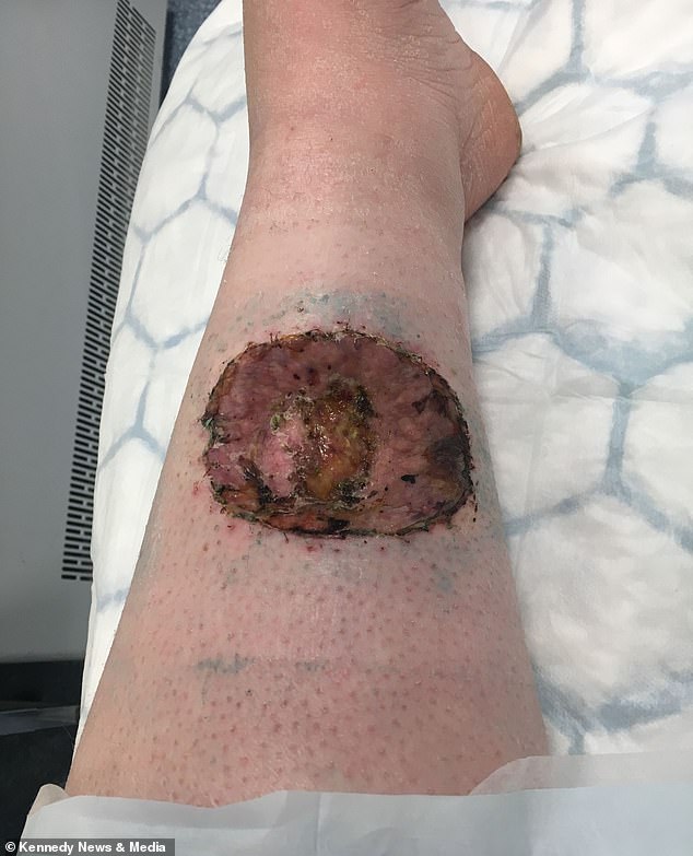 After two surgeries to remove the mole and surrounding skin from her leg, she needed a skin graft to cover the incision, leaving her with the 