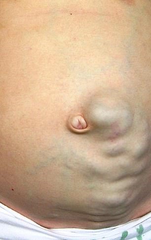 The Medusa head, which extends outward from the navel, is often a sign of advanced liver failure, known as cirrhosis.