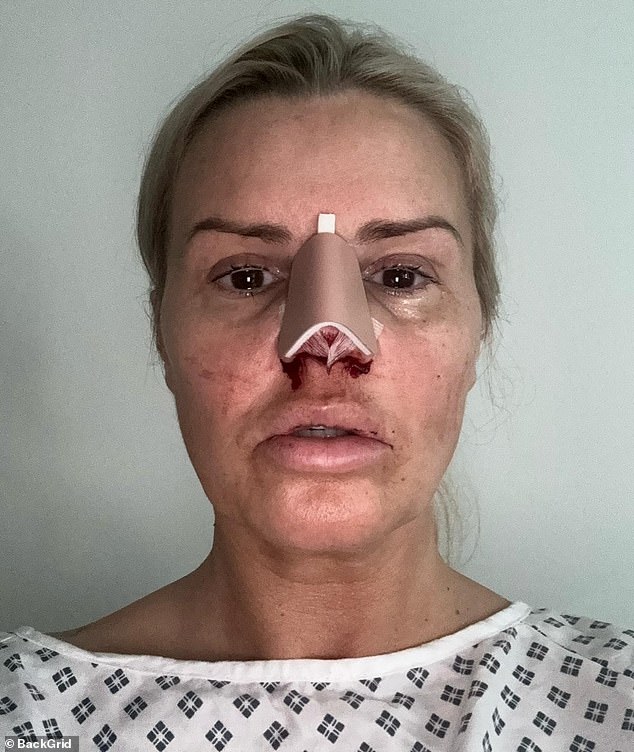 Kerry revealed the gruesome results of her nose job after going under the knife