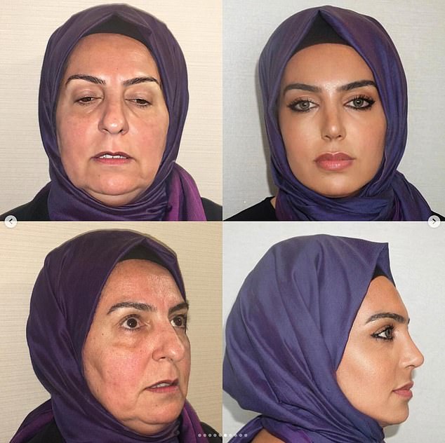 A hijab-wearing woman, known as Miss Dilek, was photographed two years after rhinoplasty, facelift and blepharoplasty surgery, according to Este's Instagram.