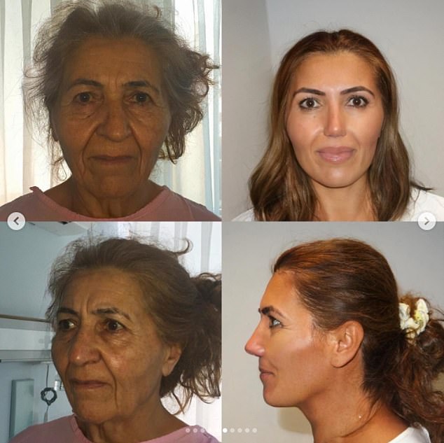 According to This Hospital, Mariam underwent skin rejuvenation and a laser face lift, as well as neck lift surgeries, upper and lower blepharoplasty procedures, fat injections and a rhinoplasty.