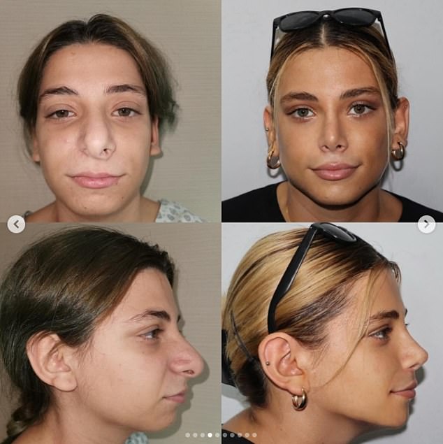 Nadya is pictured two years after her rhinoplasty, V-shaped jaw, cheek lift, under-eye bag rejuvenation and temporary lift procedures, according to This Hospital.