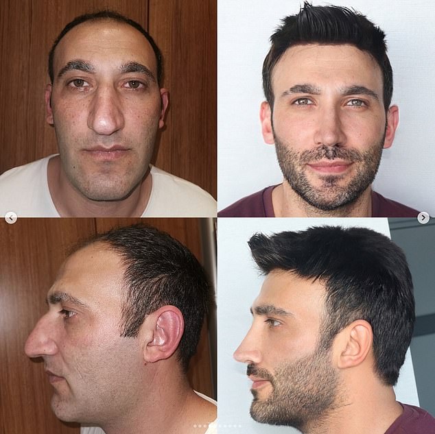 Sousa underwent a nose job and V-shaped jaw surgery. He claimed that two years passed between sets of photos.