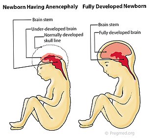 Anencephaly is the absence of the upper portion of the fetal brain, believed to be the result of acrania.