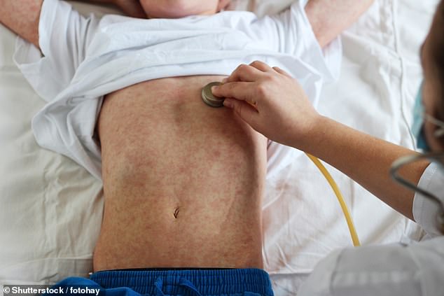 Measles usually starts with cold-like symptoms, before causing a rash made up of small red dots, some of which may feel slightly raised.