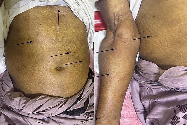 A 50-year-old man in Somalia narrowly escaped death after being stung, doctors have revealed.  He suffered multiple organ failure almost a week after being stung by a giant bee.  Sharing his case in an academic journal as a warning, doctors said such stings can also lead to strokes or even heart attacks.