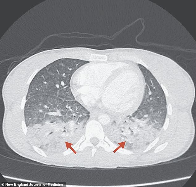 The unnamed patient suffered a partial lung collapse and a 'crackling sound', which was due to toxoplasmosis-induced pneumonia.