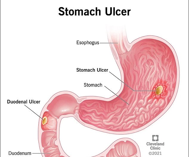 Stomach ulcers are small sores that develop in the lining of the stomach or small intestine and can cause a range of gastrointestinal symptoms, from nausea and bloating to vomiting and dizziness.