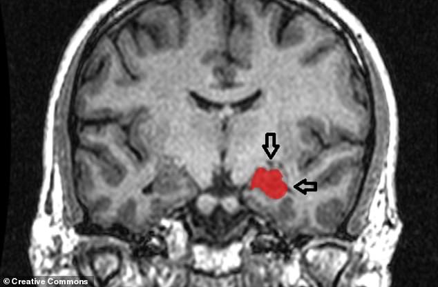 Research on brain anatomy has shown that the degree of a person's psychopathic tendencies appears to be related to smaller sizes of the hippocampus (pictured, MRI), a part of the brain critical for making detailed representations from memory.