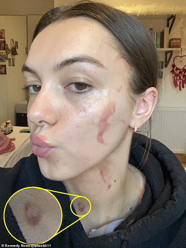 Phoebe Mason, 21, from Manchester, suffered second-degree burns after a plate of Heinz Spaghetti Hoops exploded in her face.
