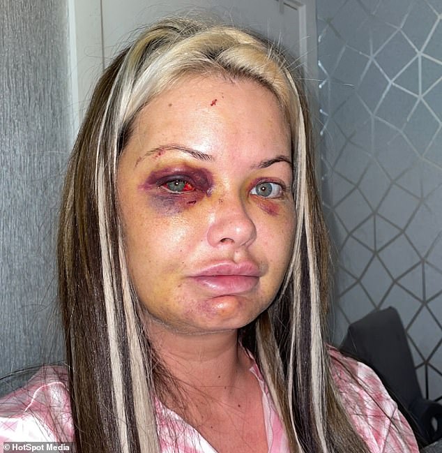 Jodie Beck, 32, thought she was going to die when her boyfriend hit her so hard her eyes felt like they were going to pop out of her head.