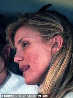 Cameron Diaz pictured above in 2002 in West Hollywood with blotchy skin and looking angry