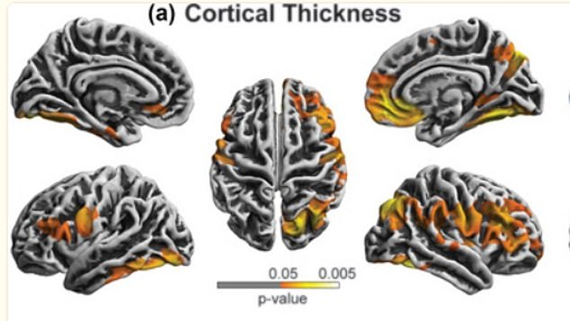 Areas illuminated in red and orange represent the choking group that had thicker brain areas in many regions, including parts of the frontal, temporal, parietal and occipital lobes, in both hemispheres involved in a long list of processes including facial recognition , decision making. Decision making, self-awareness and motor movements.