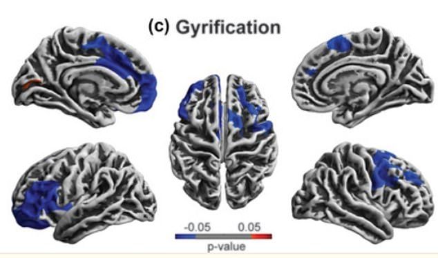 Areas in blue represent the asphyxiation group that exhibited significantly less brain folding (gyrification) compared to the non-asphyxiation group in several brain regions involved in decision making, planning, emotional regulation, reward processing , language and speech processing.