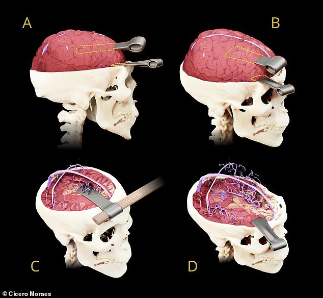 One of the weapons pierced the superior sagittal sinus, which likely caused the bleeding that caused Tao's last breath (image C)