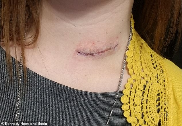 Jessica was left with a scar after surgery to remove the wire bristle that had become stuck in her throat.