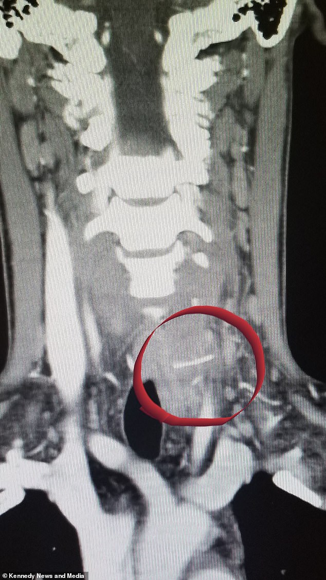 An X-ray and CT scan confirmed that a metal bristle was piercing his esophagus; However, a four-hour procedure to retrieve the cable was unsuccessful and left Jessica unable to speak for 28 days.