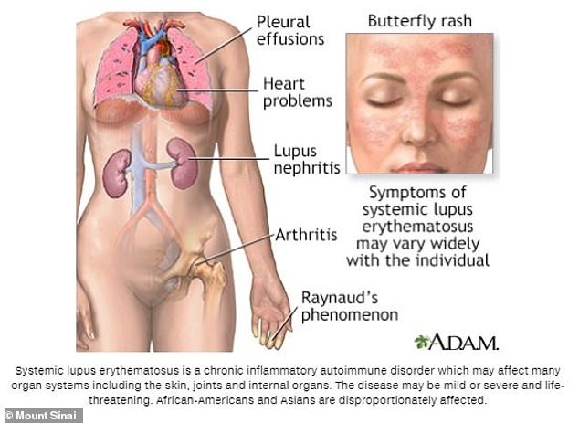 Symptoms of lupus include pleural effusions (fluid buildup in the lungs), heart and kidney problems, arthritis, and Raynaud's phenomenon (when the fingers turn white or blue in response to stress or cold). A butterfly-shaped rash on the face is also a key sign.