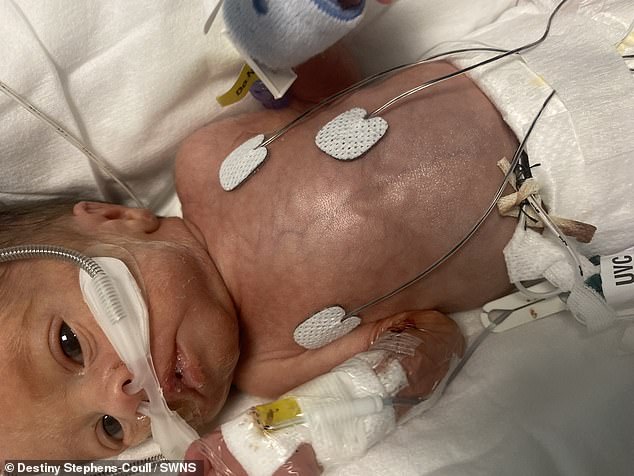 Kingsley, pictured, had to fight for his life after being born 10 weeks early by his unsuspecting mother.