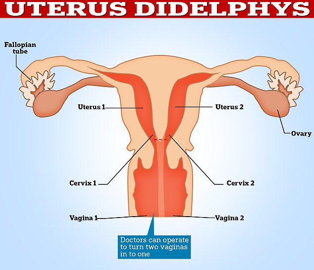 While all women born with a didelphys uterus have two uteruses, only a fraction also have two separate cervixes and vaginas. Each uterus has its own fallopian tube and ovary. Many women with this anatomical anomaly do not even know they have it because they do not suffer any symptoms. In most cases, they are only diagnosed during pregnancy when their condition is revealed through routine scans and tests.