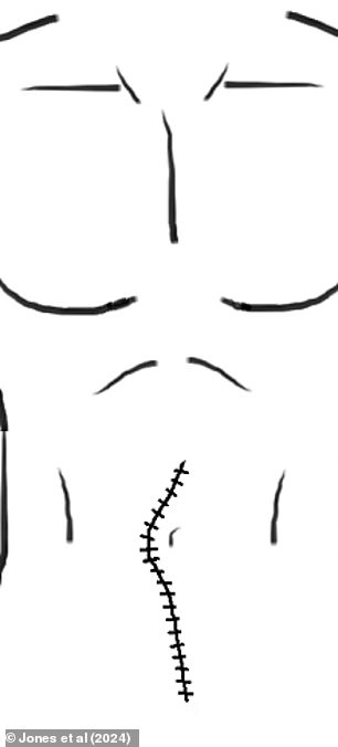 The above is an illustration from the patient's case report showing the man's incision after doctors repaired his evisceration.