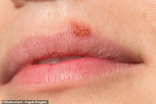 In adults, cold sores, caused by the herpes simplex virus, are not only common, but can also 