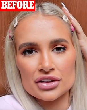 The former Love Island contestant, 25, has been documenting having her fillers removed since 2020 (pictured in 2019).