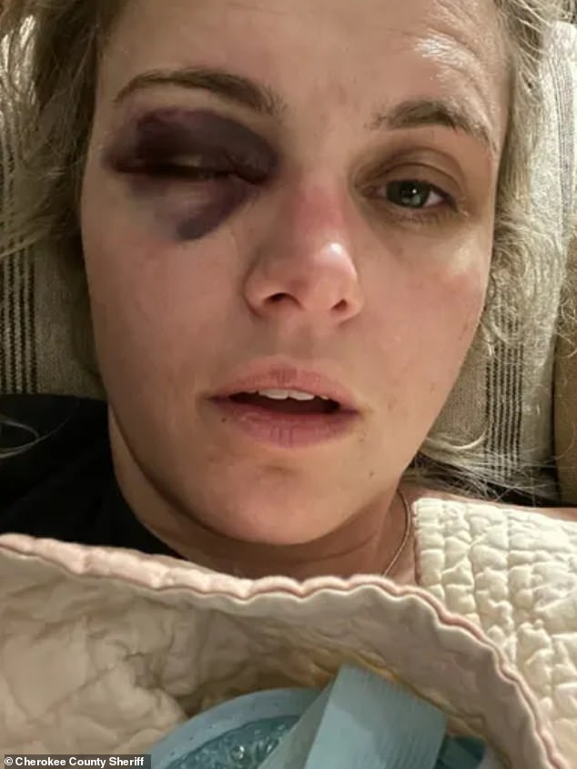 The black eye Morgan suffered from being hit repeatedly with the butt of a gun