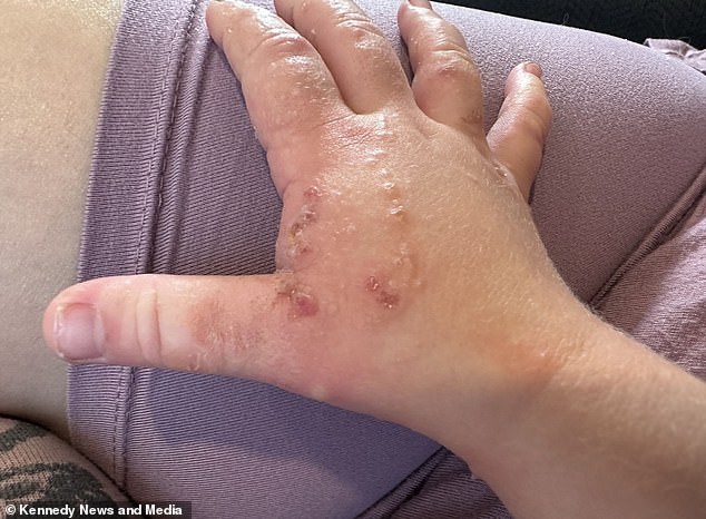 The burns required treatment with a topical steroid.