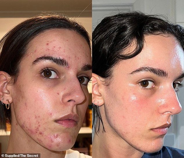 1718339737 559 How I Transformed My Skin and Eliminated My Pimples After