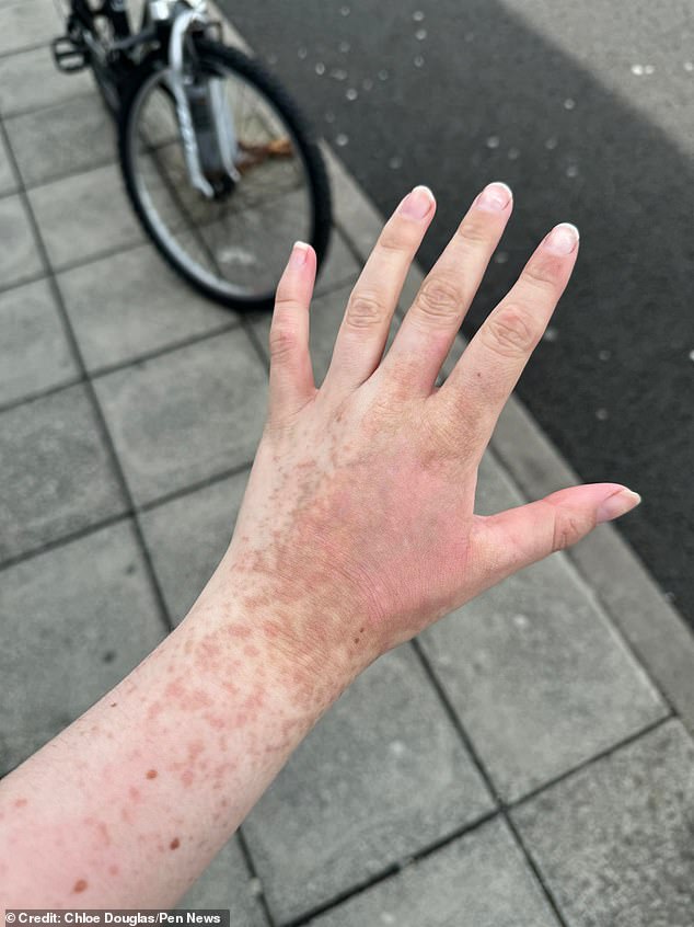 He couldn't remember ever encountering the dreaded giant hogweed and assumed it had had a bad reaction to a lounge chair.