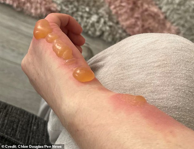 The red rash turned into nasty, painful blisters as the day progressed and she went to seek medical help.