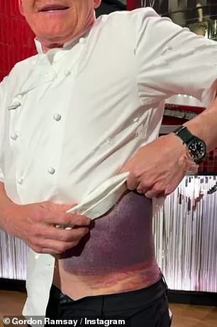 In the video, Gordon lifted his chef's jacket to reveal his injuries, which showed one side of his body covered in black and purple bruises.